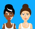 Women with vitiligo and different eye colors. Portrait. Vector.